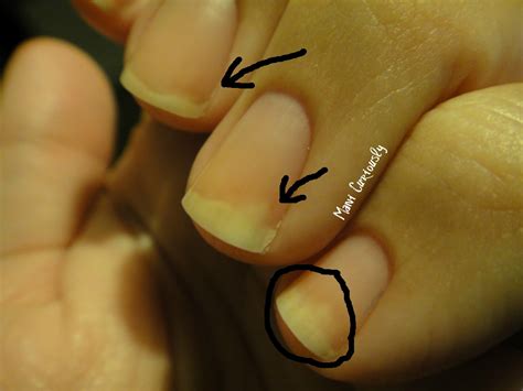 Mani Curiously...: Devastated... Nail fungus is among us!