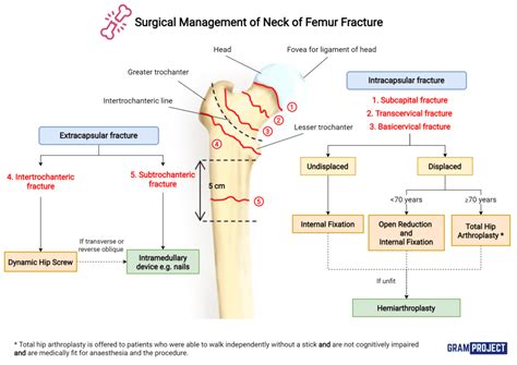 Surgical Management of Fracture NOF - Gram Project