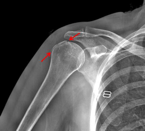 Humerus Greater Tuberosity Fracture