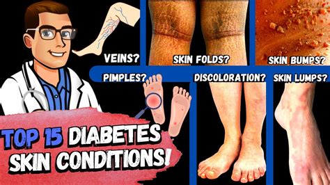 TOP 15 Diabetes Skin Signs & Symptoms [Type 2 & 1 Diabetes Mellitus]