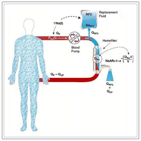 Kidney Dialysis, Types, Working, Procedure, and More - Engiomed