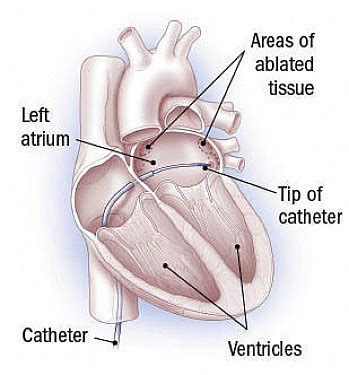 Ablation for atrial fibrillation - Harvard Health