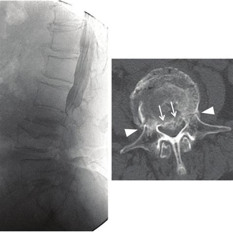 Preoperative MRI images showing the three types of burst fracture ...