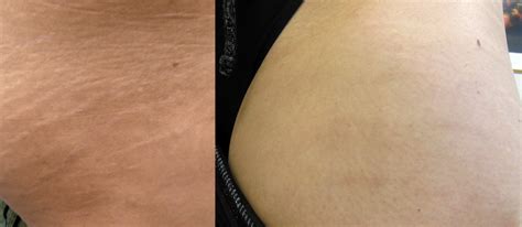 Laser Stretch Mark Removal Treatment | London Premier Laser