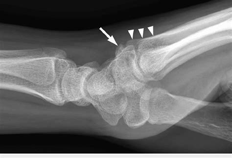 Lateral radiographic projection of the symptomatic wrist demonstrating... | Download Scientific ...