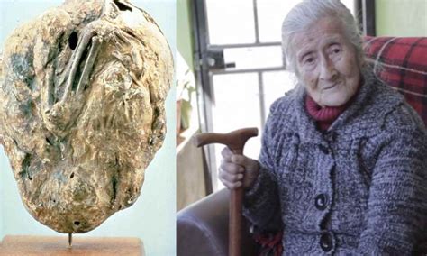 Doctors Found A 60-year-old Mummified, 'Stone Baby' Inside A 91-Year-old Woman!