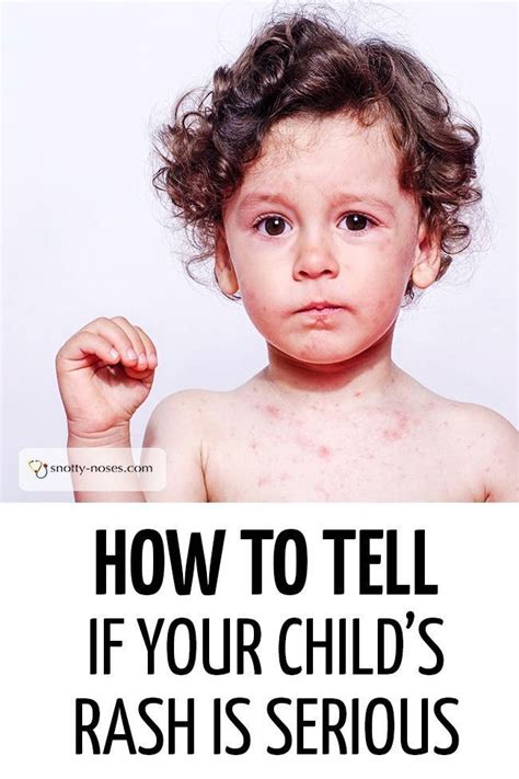 Spotty child? How to tell if your child's rash is serious. A great guide to childhood rashes by ...