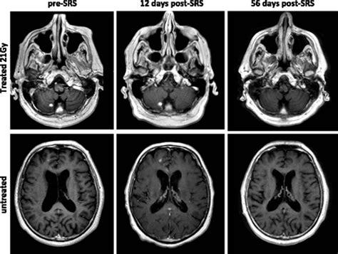 Melanoma brain metastases treated with stereotactic radiosurgery and concurrent pembrolizumab ...