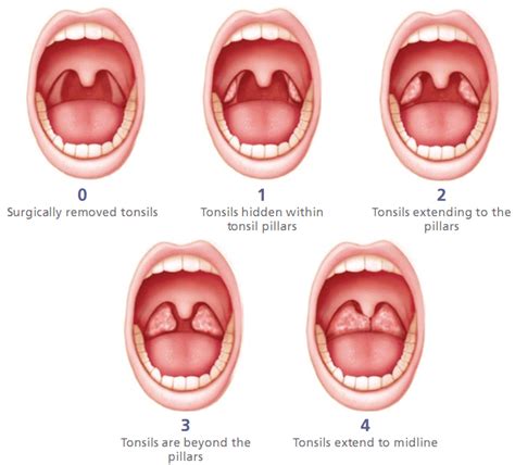 Tonsil Size Scoring | sleepmedicineboardreview