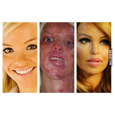 Amazing recovery of model Katie Piper before and after an acid attack ...