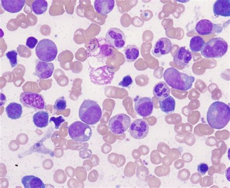 Lymphocytes Low, High - Causes