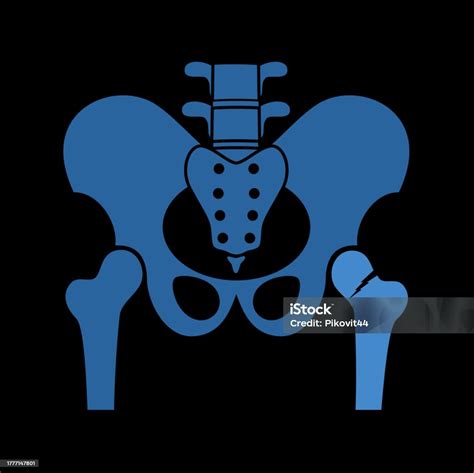 Hip Bone Fracture Stock Illustration - Download Image Now - Anatomy ...