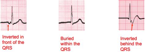 Introduction Part 1 - EKG Lesson #314