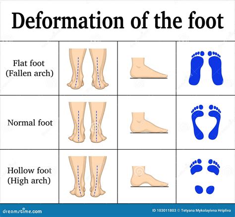 Foot Supination And Pronation Vector Illustration. Labeled Medical ...