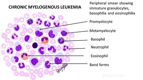 Peripheral smear findings in Leukemia – Illustrated | Pathology Made Simple