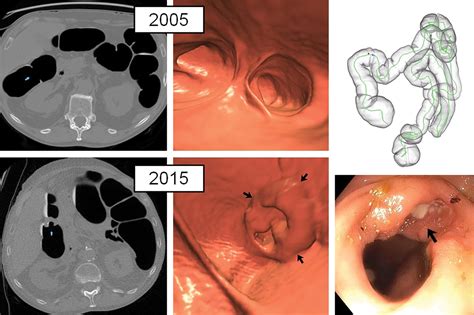 Colorectal Findings at Repeat CT Colonography Screening after Initial CT Colonography Screening ...