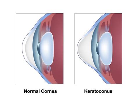 Keratoconus Denver, CO - Hines Sight