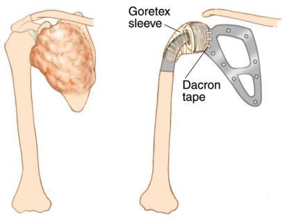 Total Scapula Prosthetic Replacement