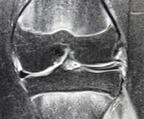 Coronal slice of MRI showing discoid lateral meniscus with complex ...