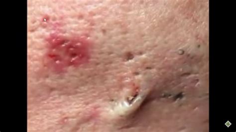 LARGE Blackheads Removal #003 - YouTube