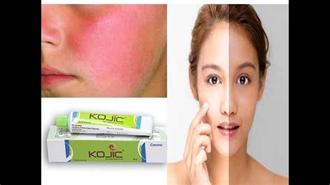 Kojic acid lightening cream Review And Side Effects in Tamil - YouTube