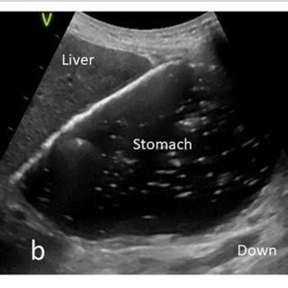 (PDF) Point-of-Care Gastric Ultrasound Confirms the Inaccuracy of ...