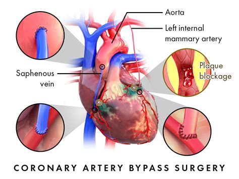 Expert CABG Surgery in Hyderabad - Top Cardiac Surgeons