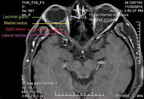 Radiology Anatomy Images : Orbit MRI Anatomy