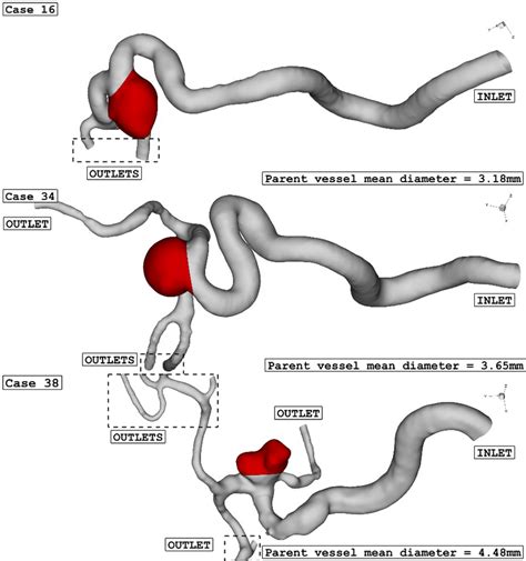 ICA aneurysm geometry of 3 different cases. | Download Scientific Diagram