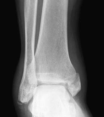 Ankle Fracture Imaging: Practice Essentials, Radiography, Computed ...