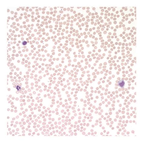 Peripheral blood smear with normocytic normochromic red blood cells ...