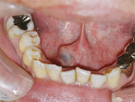 Intraductal papilloma arising from sublingual minor salivary gland: Case report and ...