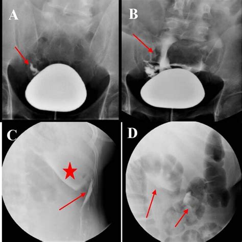 Retrograde cystography. (A and B) Frontal view of retrograde ...