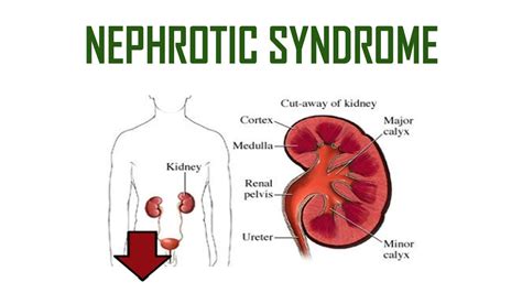 Nephrotic Syndrom | Causes, Symptoms & Treatment | Iqbal Health Centre ...