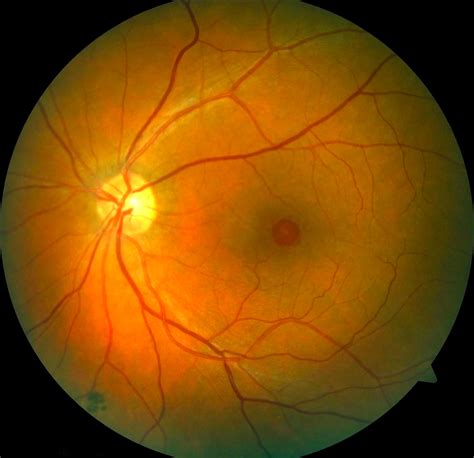 Eye Diseases | Retina & Macula | Cataract & Glaucoma