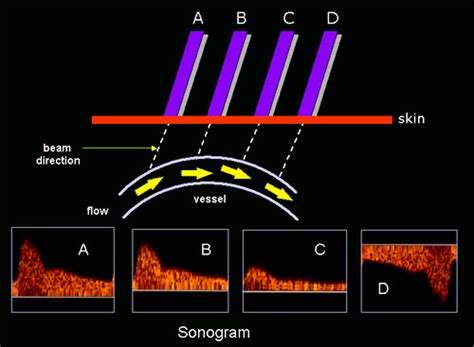 Doppler sonography/physical principle - WikiLectures