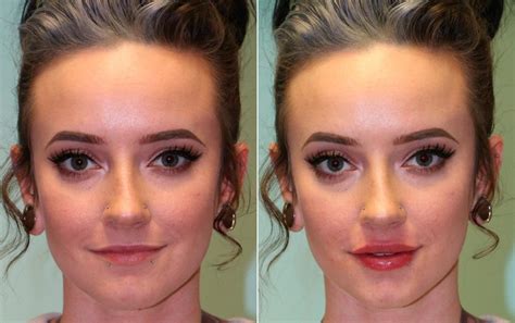 Lip Injections before and after photos - The Naderi Center for Plastic ...