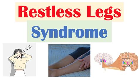 Restless Legs Syndrome (RLS) | Causes, Signs & Symptoms, Diagnosis, Treatment - YouTube