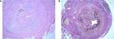 Temporal artery biopsy results showing (A) giant cells (black arrows ...