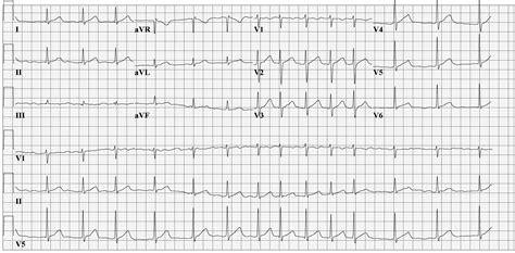 Atrial fibrillation EKG examples - wikidoc