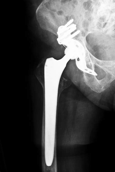 Metal on Metal Hip Implants: FAQs in California