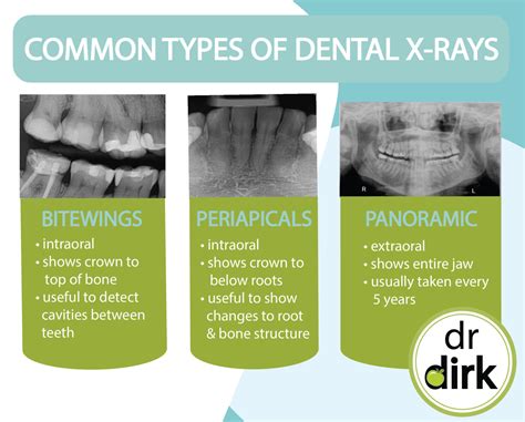 Types of Dental X-Rays At Our Calgary Dentist Office - Advance Your ...