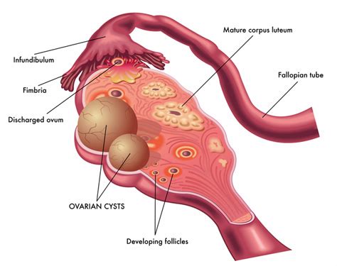 Ovarian Cyst Symptoms: How They Develop, How to Treat Them | University Health News