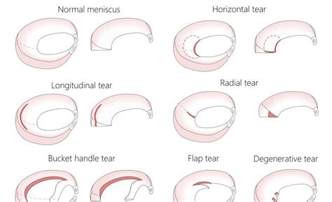 Meniscus Injections: An Option for Knee Relief - Sport Doctor London