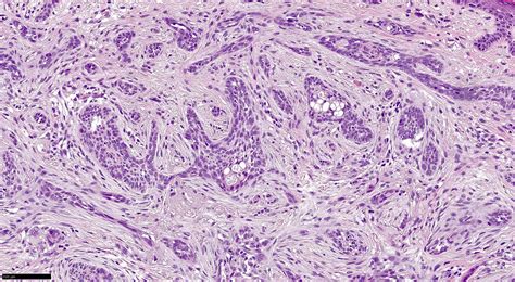 Squamous Cell Carcinoma Vs Basal Cell Carcinoma Histology