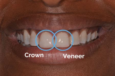 Crown vs veneer after with text - Central Park West Dentistry