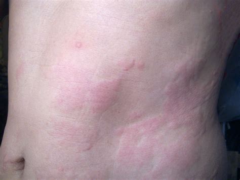 Hives Due to Heat or Exercise (Cholinergic Urticaria)