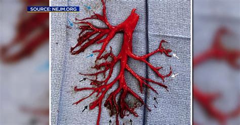 UCSF Patient Coughs Up Huge Blood Clot Shaped Like Lung - CBS San Francisco