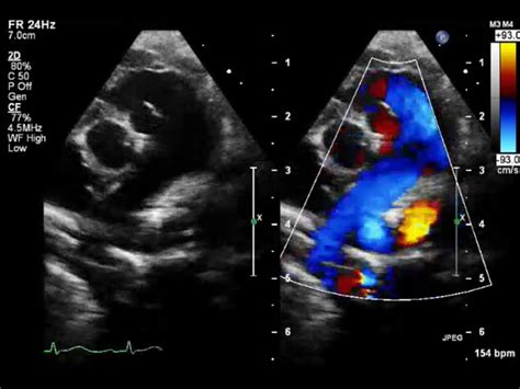 Pediatric Echocardiography