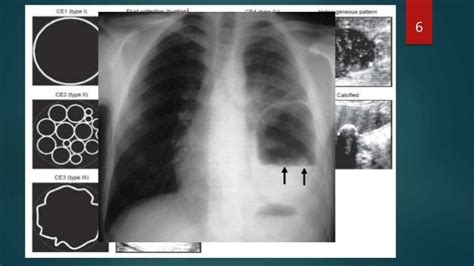 Echinococcosis, signs and symptoms, diagnosis and management.